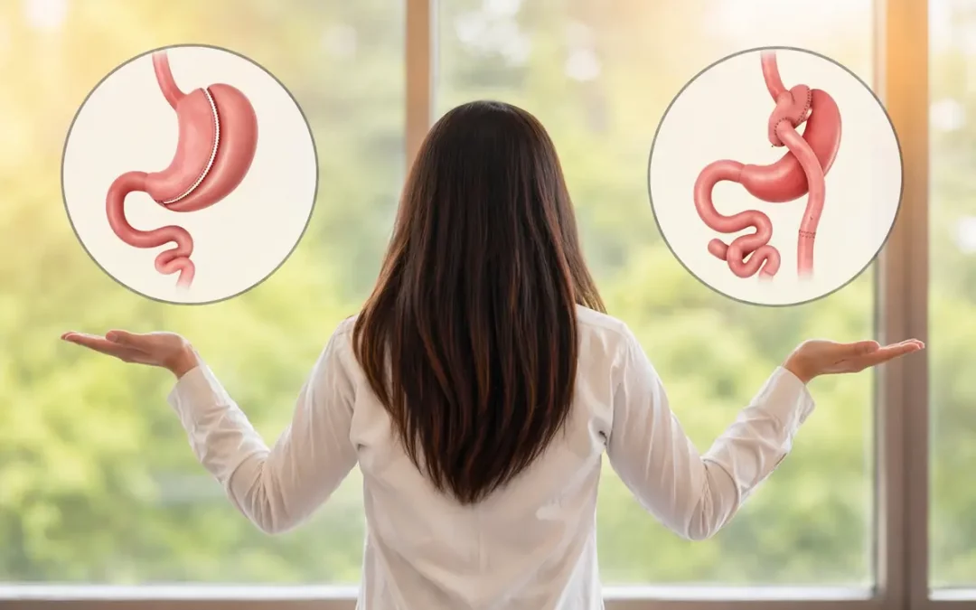 Cirugía bariátrica: ¿manga gástrica o bypass gástrico?